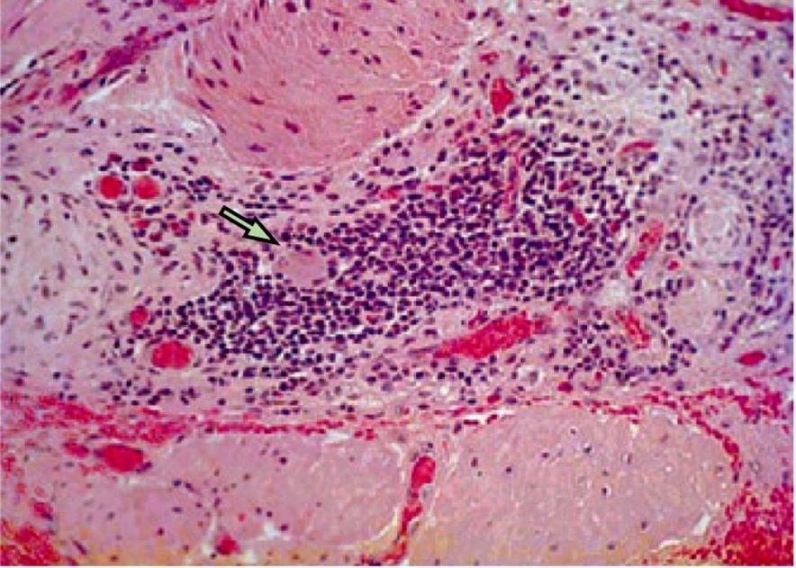 ΠΑΘΟΓΕΝΕΙΑ Αρχικό αίτιο: Ιός (HSV-1, HPV, ιλαρά)? τοξίνη?