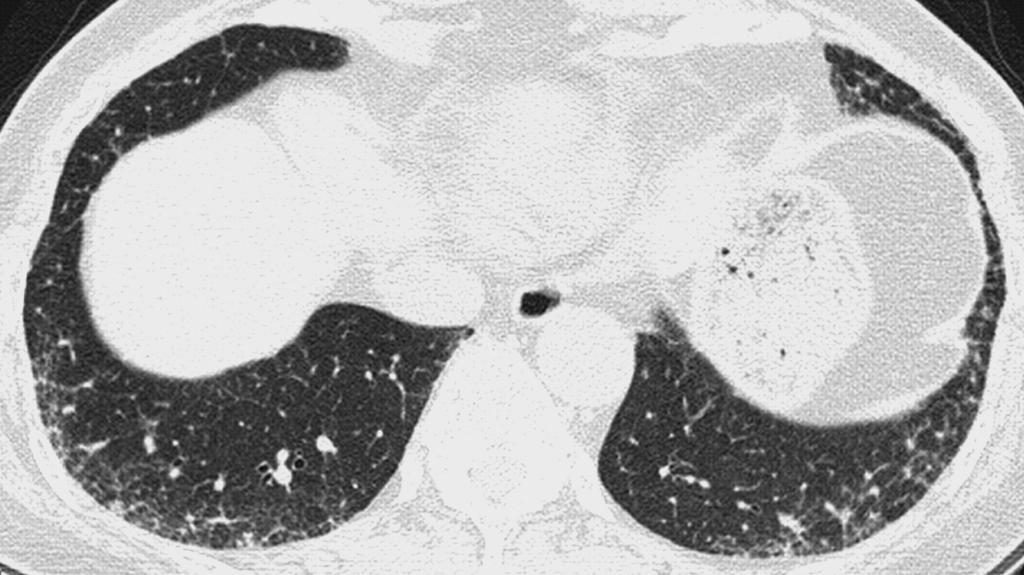 Fleischner: PROBABLE UIP HRCT: