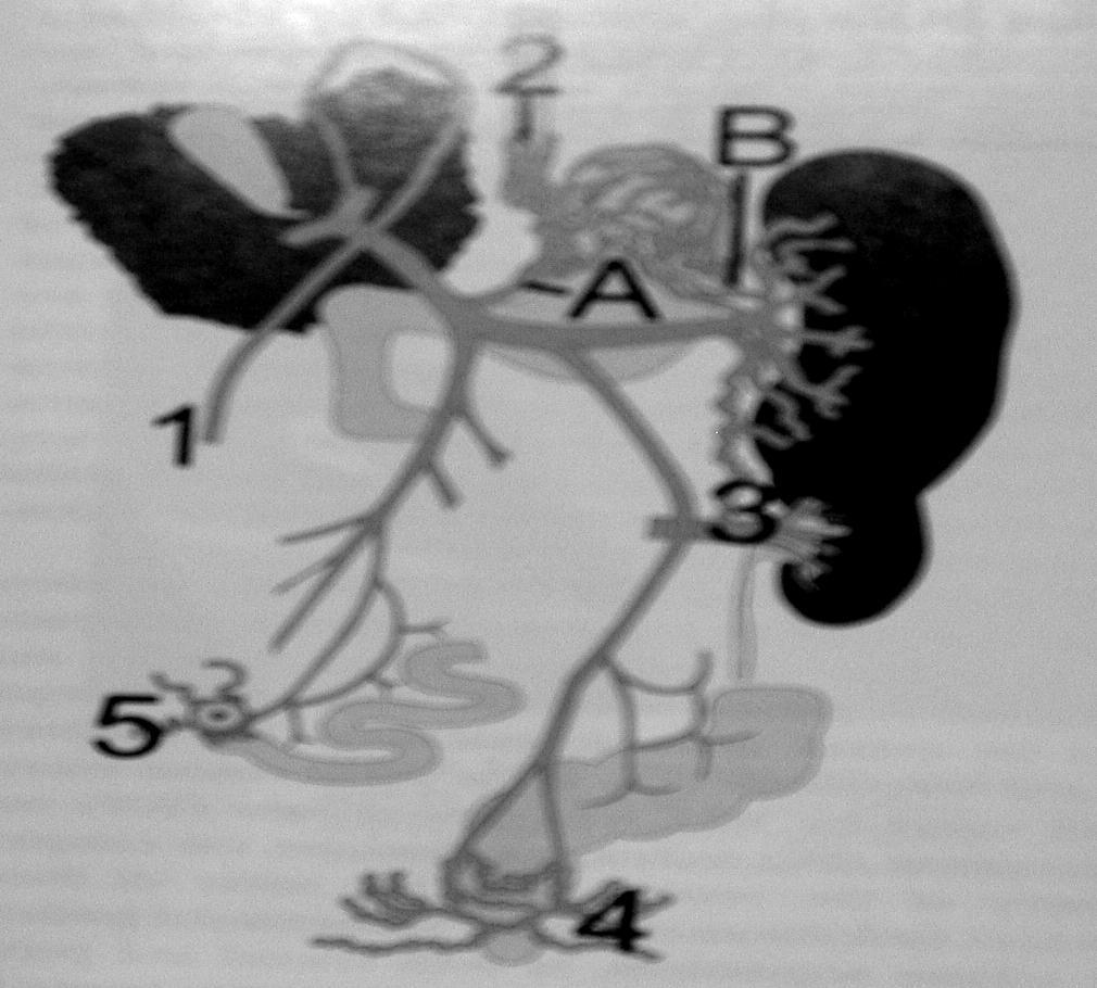 -23- Εικόνα 21 Συνήθεις αναστομώσεις: πυλαιοσυστηματικές 1. Ομφαλική φλέβα [προς κοιλιακό τοίχωμα]. 2. Κιρσοί οισοφάγου [προς φλέβες μεσοθωρακίου]. Α)Στεφανιαία στομάχου Β)Βραχείες γαστρικές 3.
