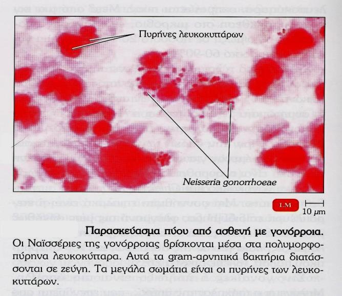 Gram χρώση ουρηθρικού εκκρίματος Αρχικός έλεγχος σε συμπτωματικό άνδρα μόνο: άμεσο παρασκεύασμα ουρηθρικού και Gram stain Σημ.