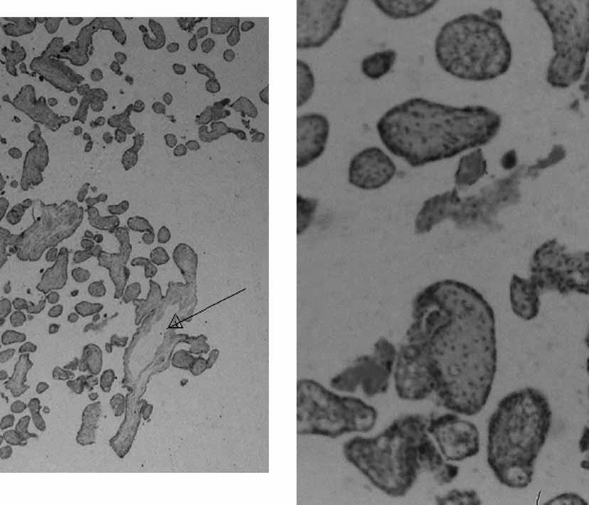 Μερική μύλη κύηση με χρωμοσωμικά και φαινοτυπικά υγιές έμβρυο Παπουτσής και συν. Εικόνα 3. Αριστερά: Φυσιολογικές λάχνες και λάχνες με υδατιδώδη εκφύλιση (μαύρο βέλος). Χρώση Η-Ε, μεγέθυνση 2Χ.