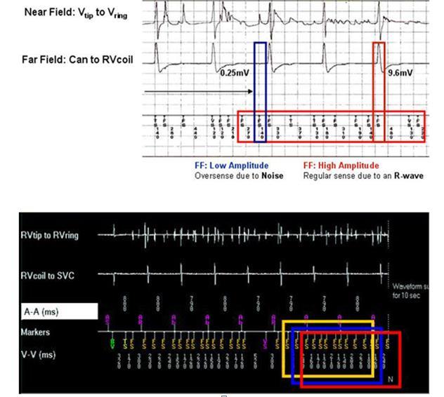 Ο αλγόριθμος για τη διάγνωση θορύβου(the RV Lead Noise Discrimination algorithm Medtronic) διακρίνει το θόρυβο του ηλεκτροδίου από επεισόδια VT/VF συγκρίνοντας τα farfield EGM (RV coil to SVC/can to