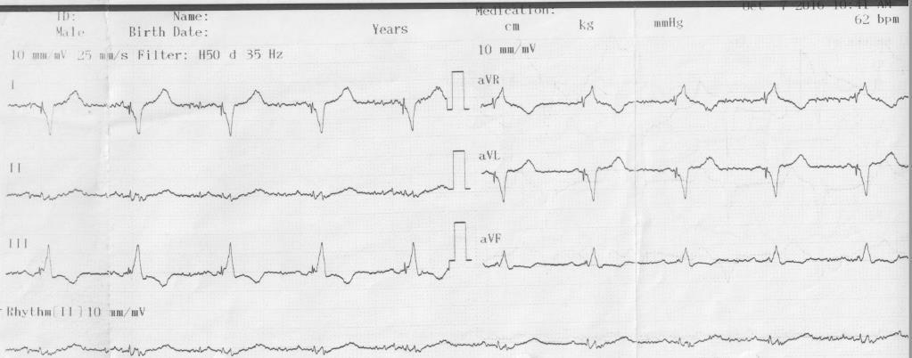 Έγινε εμφύτευση CRT-D Medtronic Brava Quard, χωρίς επιπλοκές