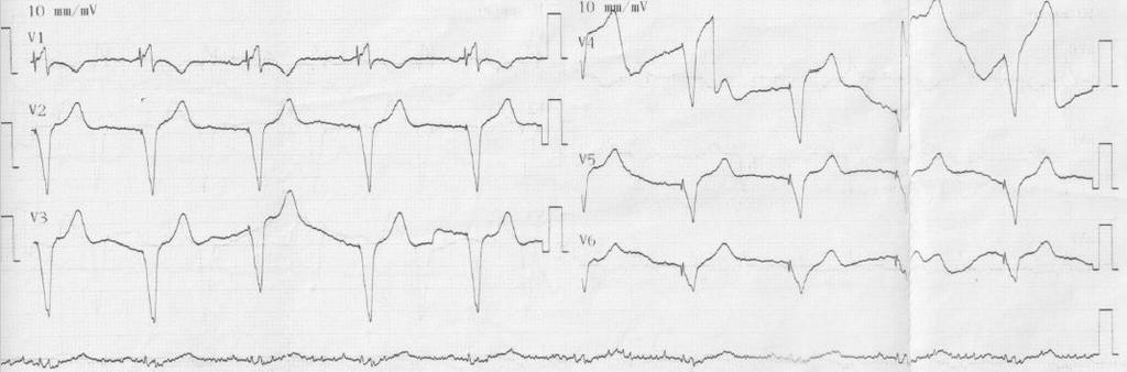 /imp 551Ω,ουδός<1 V/msec LV: imp 399Ω ουδός<1v/msec Σε follow