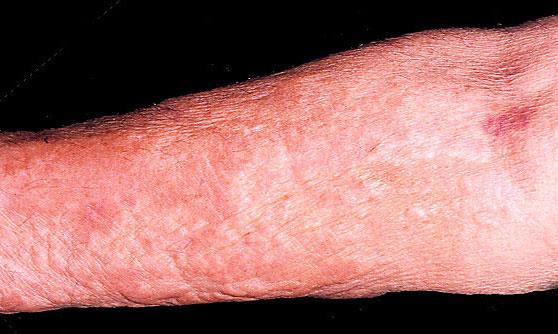 Γαδολίνιο: Νεφρογενής Συστημική Ίνωση (NFS) Ένα σπάνιο αλλά σοβαρό σύνδρομο που σχετίζεται με την ίνωση του δέρματος, των αρθρώσεων και εσωτερικών οργάνων Πρώτο αναφερθέν περιστατικό το 1997 (~600 ως