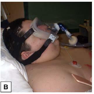 SBT: successful - hypercapnia mild respiratory acidosis 2 55