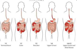 Νόσος Crohn Μπορεί να πάσχει οποιοδήποτε σημείο του πεπτικού σώλήνα