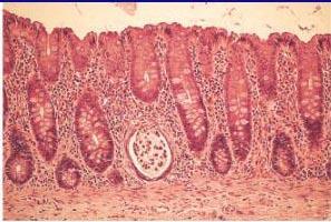 Histology Normal Infectious IBD IBD possible