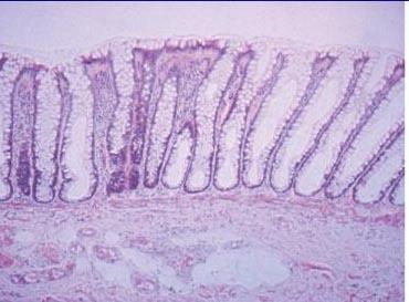 Cellular infiltration of the lamina propria