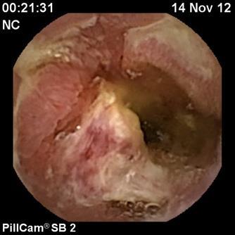 εντέρου Small Bowel