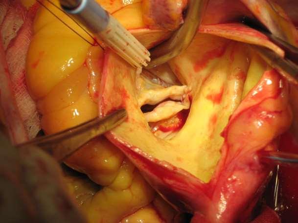 Bentall Bicuspid Aortic