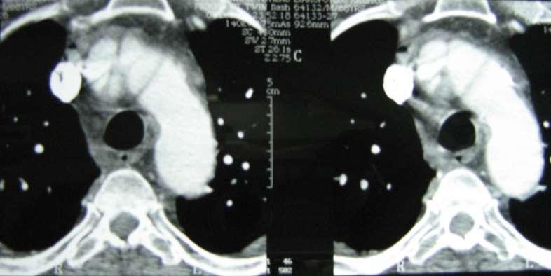 Acute Dissection Type A including the aortic