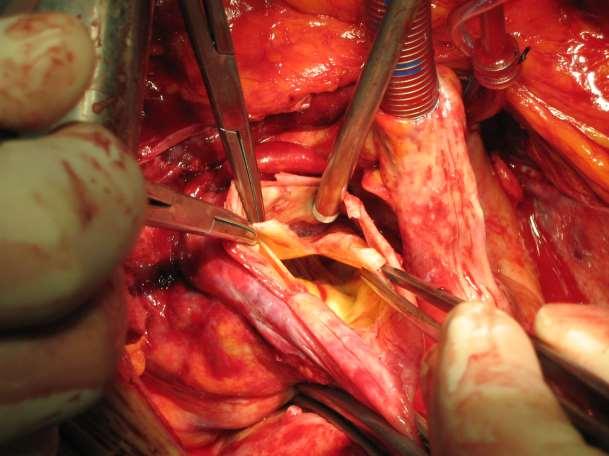 Acute Dissection Type A including the aortic arch and the