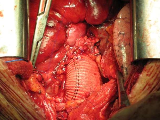 Acute Dissection Type A including the aortic arch and the