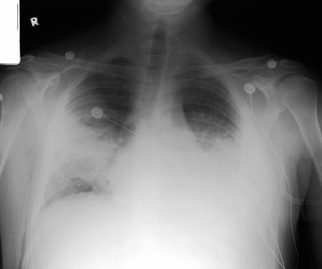 Chest X-ray: διηθήματα