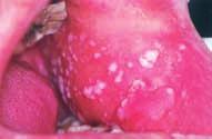 παρουσίασης των ιών HPV στο βλεννογόνο του στόµατος µε κλιµακωτή αξιοπιστία.