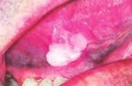 Η συµµετοχή των υψηλού κινδύνου HPV-16 και HPV-18 έχει τεκµηριωθεί ιδιαίτερα στο ακανθοκυτταρικό καρκίνωµα του στοµατοφάρυγγα (Εικ.6) και το µυρµηκιώδες καρκίνωµα (Εικ.7).