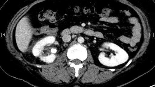 Right renal pelvic stone causing