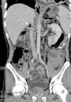 pockets around the shadow of the left kidney (arrows).