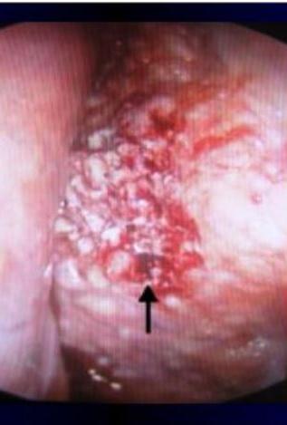 Περικαρδιοσκόπηση Επιτρέπει την απεικόνιση του περικαρδιακού σάκου (επικαρδιακά και περικαρδιακά). Οι μακροσκοπικές προβολές δείχνουν: 1. ομαδοποίηση των εμφυτεύσεων, 2.