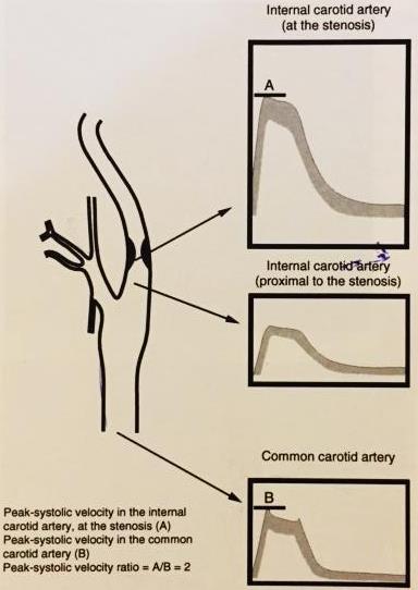 Ο ΛΟΓΟΣ ΤΩΝ ΥΨΗΛΩΝ ΣΥΣΤΟΛΙΚΩΝ ΤΑΧΥΤΗΤΩΝ ICA/CCA PSV ratio υψηλoσυστολική ταχύτητα στην έσω καρωτίδα στο επίπεδο