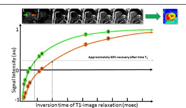 T1 mapping T1 native T1 post contrast 1,5T