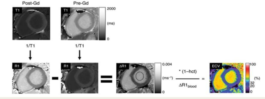 blood-pre ECV=ΔR1 myo / ΔR1 blood X (1-Hct) Υψηλότερες τιμές σε γυναίκες και