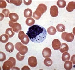 Φυσικά φονικά κύτταρα (NK cells) Τύπος µεγάλων κοκκιωδών λεµφοκυττάρων (large granular lymphocytes, LGL)