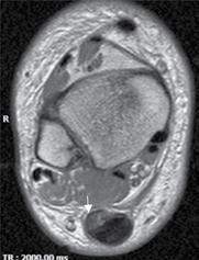 Παθολογία Τενόντων Ποδοκνημικής Άρθρωσης: Ευρήματα στην Μαγνητική Τομογραφία ΚΕΦΑΛΑΙΟ 33 249 Α Β Εικόνα 33.2 Μαγνητική Τομογραφία ποδοκνημικής άρθρωσης. Α: Τ1 ακολουθία, εγκάρσιο επίπεδο.