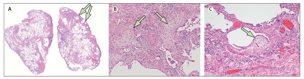 Fibrosis +