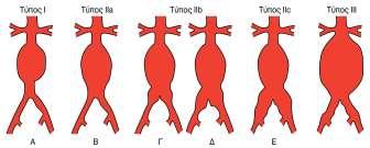 Σύγχρονη αντιμετώπιση του αορτικού