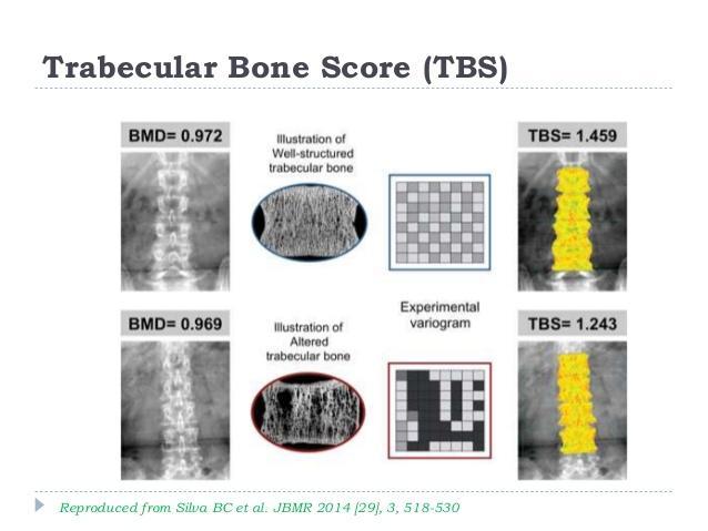 lateral BMD και TBS είχαν χαμηλότερες τιμές Μετά από προσαρμογή : TBS των L2-L3 ήταν σημαντικά μικρότερο