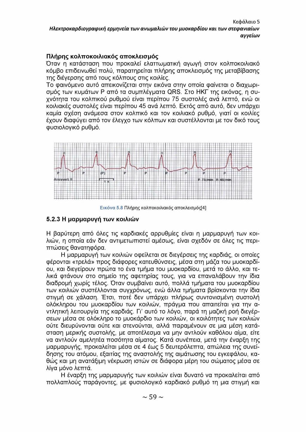 Κεφάλαιο 5 Ηλεκτροκαρδιογραφική ερμηνεία των ανωμαλιών του μυοκαρδίου και των στεφανιαίων αγγείων Πλήρης κολποκοιλιακός αποκλεισμός Όταν η κατάσταση που προκαλεί ελαττωματική αγωγή στον κολποκοιλιακό