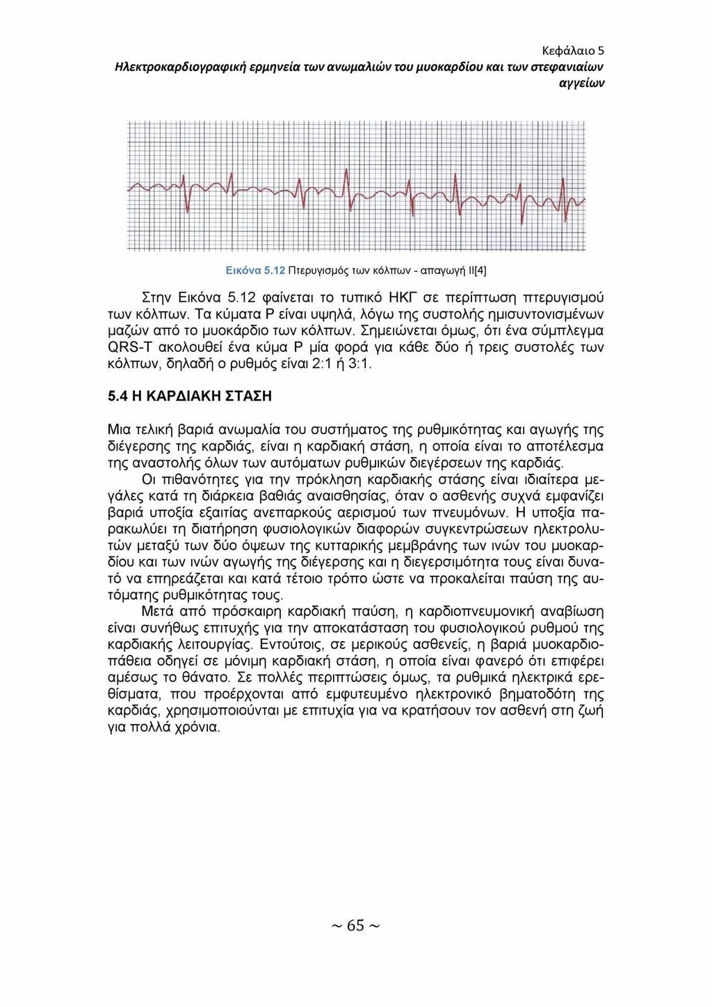 Κεφάλαιο 5 Ηλεκτροκαρδιογραφική ερμηνεία των ανωμαλιών του μυοκαρδίου και των στεφανιαίων αγγείων Εικόνα 5.12 Πτερυγισμός των κόλπων - απαγωγή ΙΙ[4] Στην Εικόνα 5.