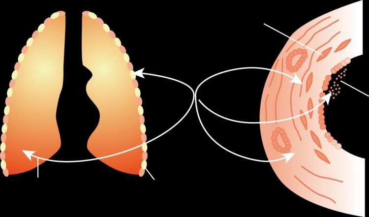 Bronchodilators are essential to symptom management in COPD Air trapping Bronchoconstriction Smooth muscle relaxation