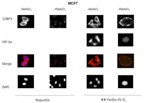 Εικόνα 31: Μικροσκοπία ανοσοφθορισμού σε καρκινικά κύτταρα MCF7 που προεπωάστηκαν σε νορμοξία ή για 4 ώρες σε υποξία πριν την προσθήκη ή μη NaAsO 2.