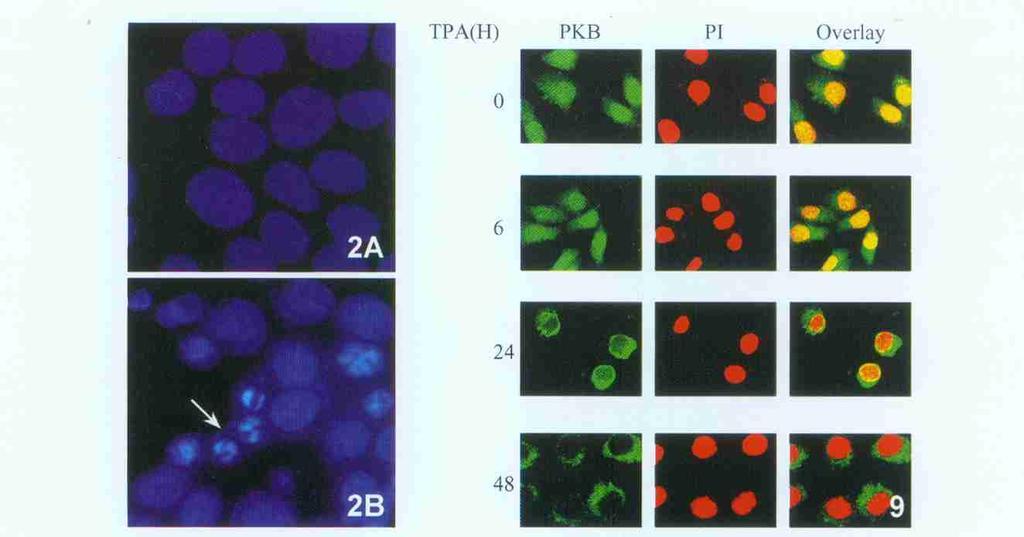212 39,2 2 TPA BGC2823 A. ; B. TPA(100 gπl),24h, 100 9 TPA BGC2823 PKB 100 Fig. 2 TPA induces cell apoptosis in gastric cancer BGC2823 cells.