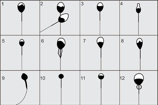 Διαγραμματική αναπαράσταση Εικονογραφημένος Άτλας της Μορφολογίας των Σπερματοζωαρίων 53 των μορφολογικών ανωμαλιών των σπερματοζωαρίων Μορφολογικές ανωμαλίες της κεφαλής Εικόνα 7.