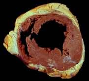 Ventricular Septal Rupture Free Wall Rupture Mitral Regurgitation (Pap.