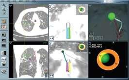 Software Planned Pathway File The patient s chest is placed between