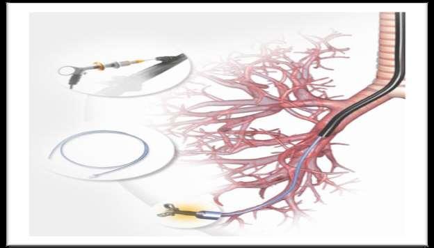 Navigation Locatable Guide (LG) Catheter together with the Extended Working Channel (EWC)
