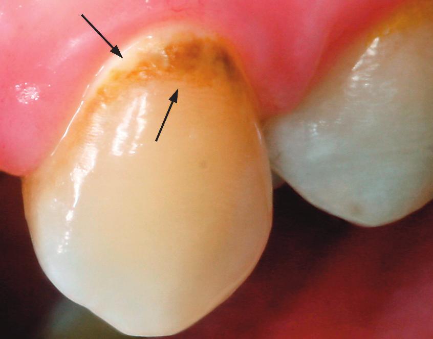 19 1  Όταν η επιφάνεια του δοντιού εξετάζεται σε ελαφρά διαβρεγμένες συνθήκες παρατηρείται είτε αδιαφάνεια (λευκή περιοχή) είτε αποχρωματισμός της (καφέ περιοχή) που δε βρίσκονται σε