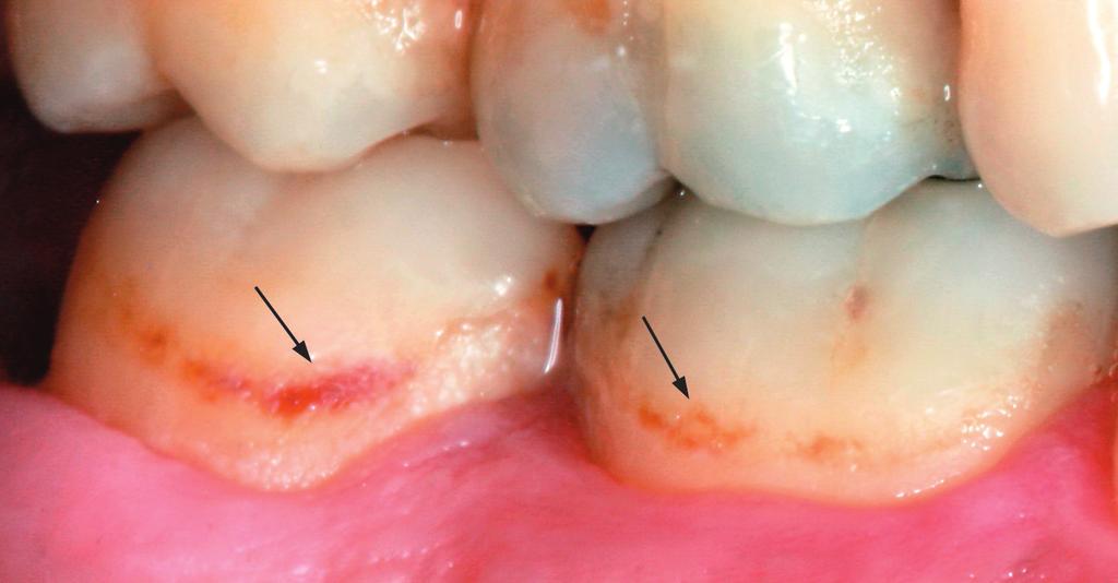 20 3 Κλινική σημειολογία. Όταν η επιφάνεια του δοντιού εξετάζεται σε ελαφρά διαβρεγμένες συνθήκες παρατηρείται είτε αδιαφάνεια (λευκή περιοχή), είτε αποχρωματισμός της (καφέ περιοχή).