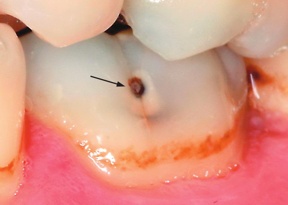 Διάγνωση. Η τερηδόνα καταλαμβάνει όλη την αδαμαντίνη (ιστολογικά διαπερνά την αδαμαντινο-οδοντινική σύναψη). Εικ. 1.26.