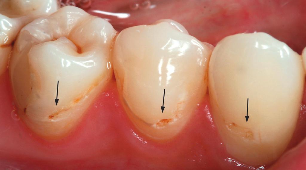 Καφέ αποχρωματισμός στην αυχενική περιοχή των δοντιών και απώλεια της επιφανειακής ακεραιότητας της αδαμαντίνης, χωρίς αποκάλυψη της υποκείμενης οδοντίνης (βαθμός 3). Κλινική σημειολογία.