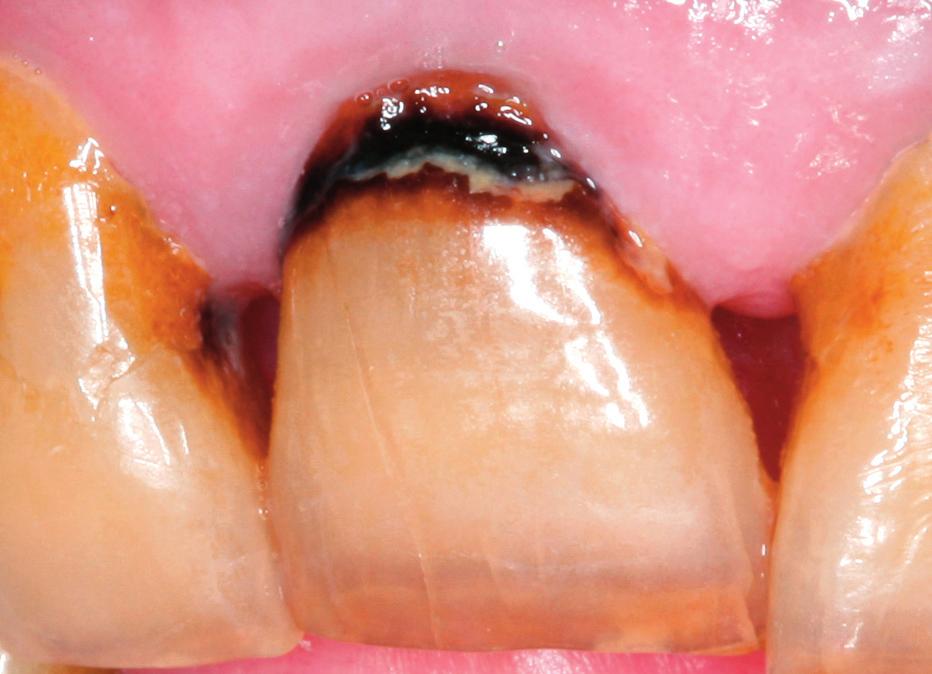 Κλινική σημειολογία. Είναι ορατός ο σχηματισμός ανοικτής κοιλότητας με έκθεση της υποκείμενης οδοντίνης. Η αδαμαντίνη είναι αδιαφανής ή αποχρωματισμένη (Εικ.