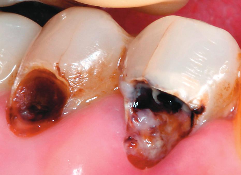 Η οδοντίνη είναι ορατή στο βάθος και στα πλάγια τοιχώματα της κοιλότητας.