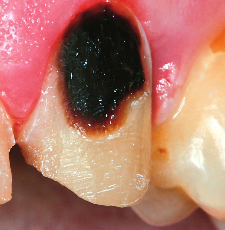 Διάγνωση: Η τερηδόνα καταλαμβάνει όλη σχεδόν την οδοντίνη (ιστολογικά αντιστοιχεί στο εσωτερικό τριτημόριο της οδοντίνης και πιθανόν πέραν αυτού, μέχρι τον
