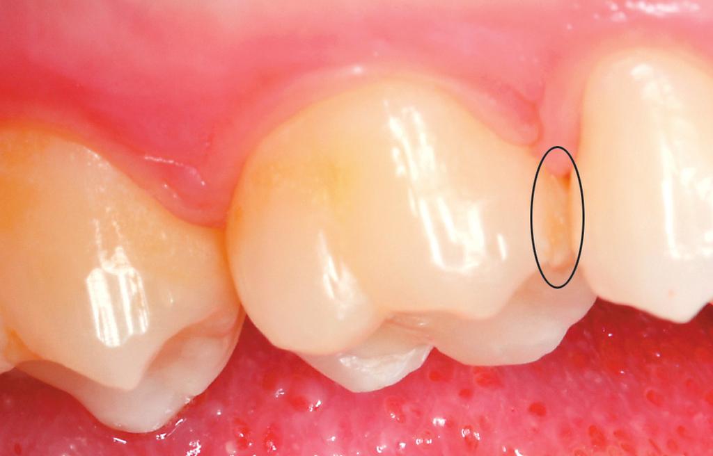 αποχρωματισμός (λευκή ή καφέ περιοχή) που δε βρίσκεται σε συνέχεια με την κλινική εμφάνιση της υγιούς αδαμαντίνης. Η βλάβη αυτή είναι ορατή από παρειακή ή γλωσσική κατεύθυνση (Εικ. 1.35, 1.36).