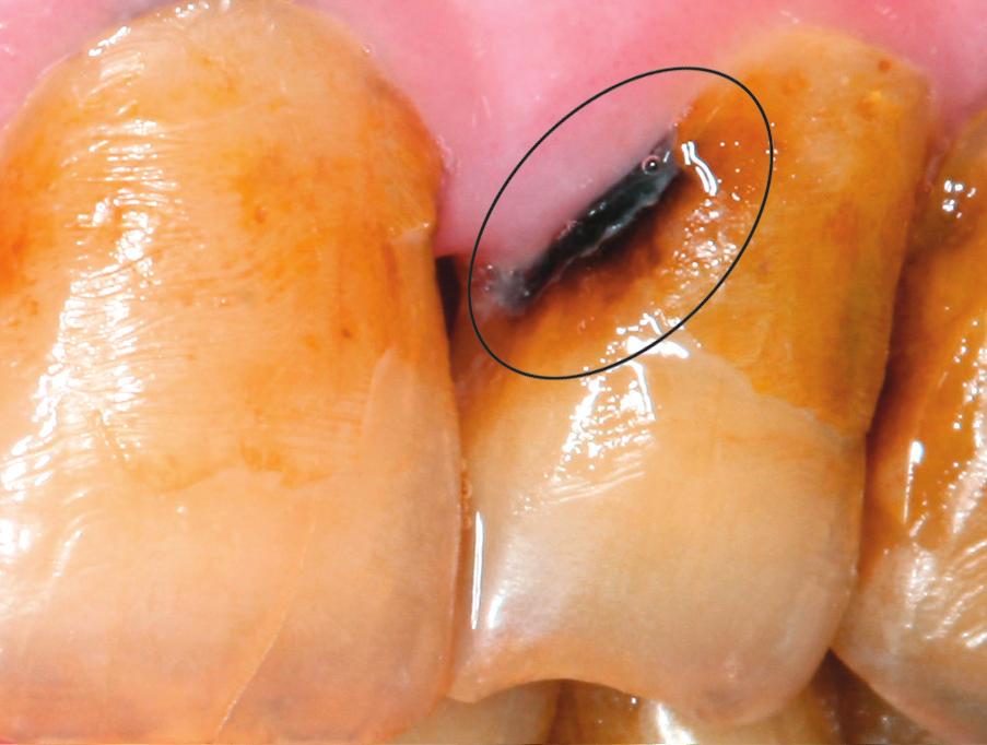 Όταν η επιφάνεια του δοντιού εξετάζεται ελαφρά διαβρεγμένη, παρατηρείται είτε αδιαφάνεια (λευκή περιοχή) είτε αποχρωματισμός της (καφέ περιοχή).